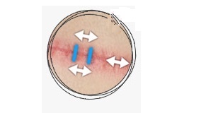 Traitement des Cicatrices Casablanca