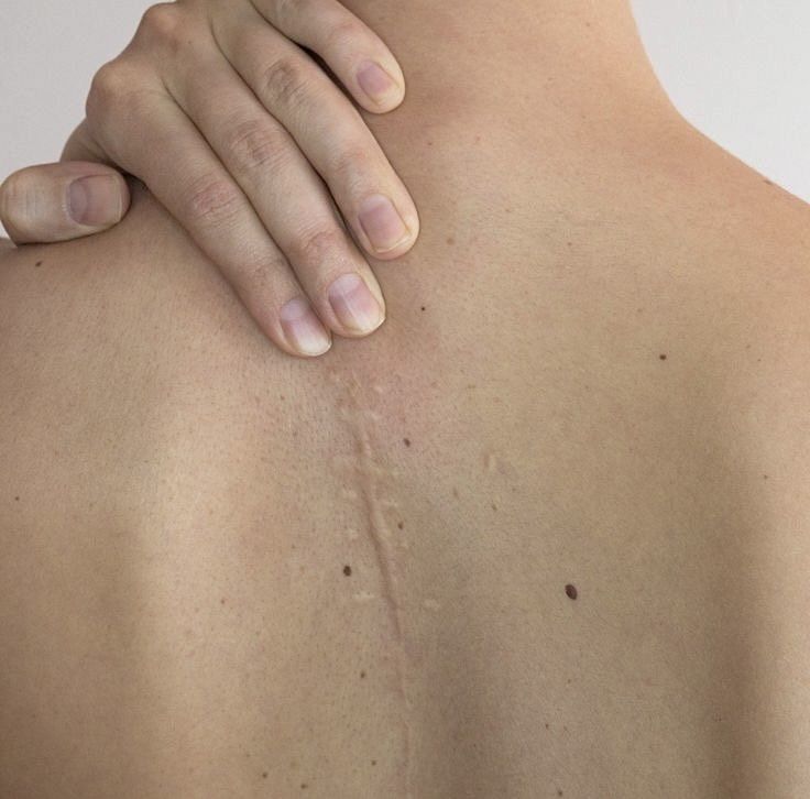 Traitements des cicatrices Casablanca