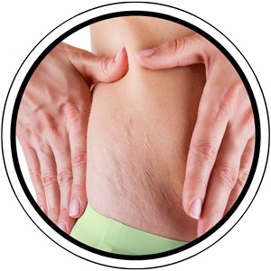 Traitement Vergetures Bloomea au Centre BOTUHA Casablanca